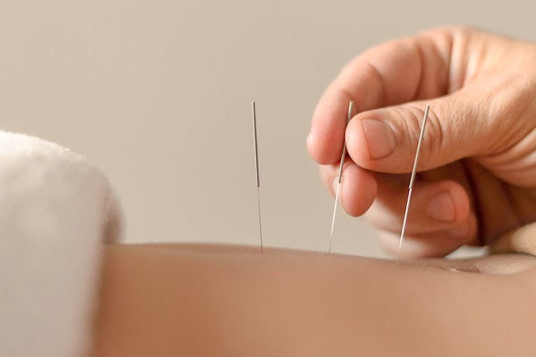 Acupuntura como Terapia Complementar após um AVC